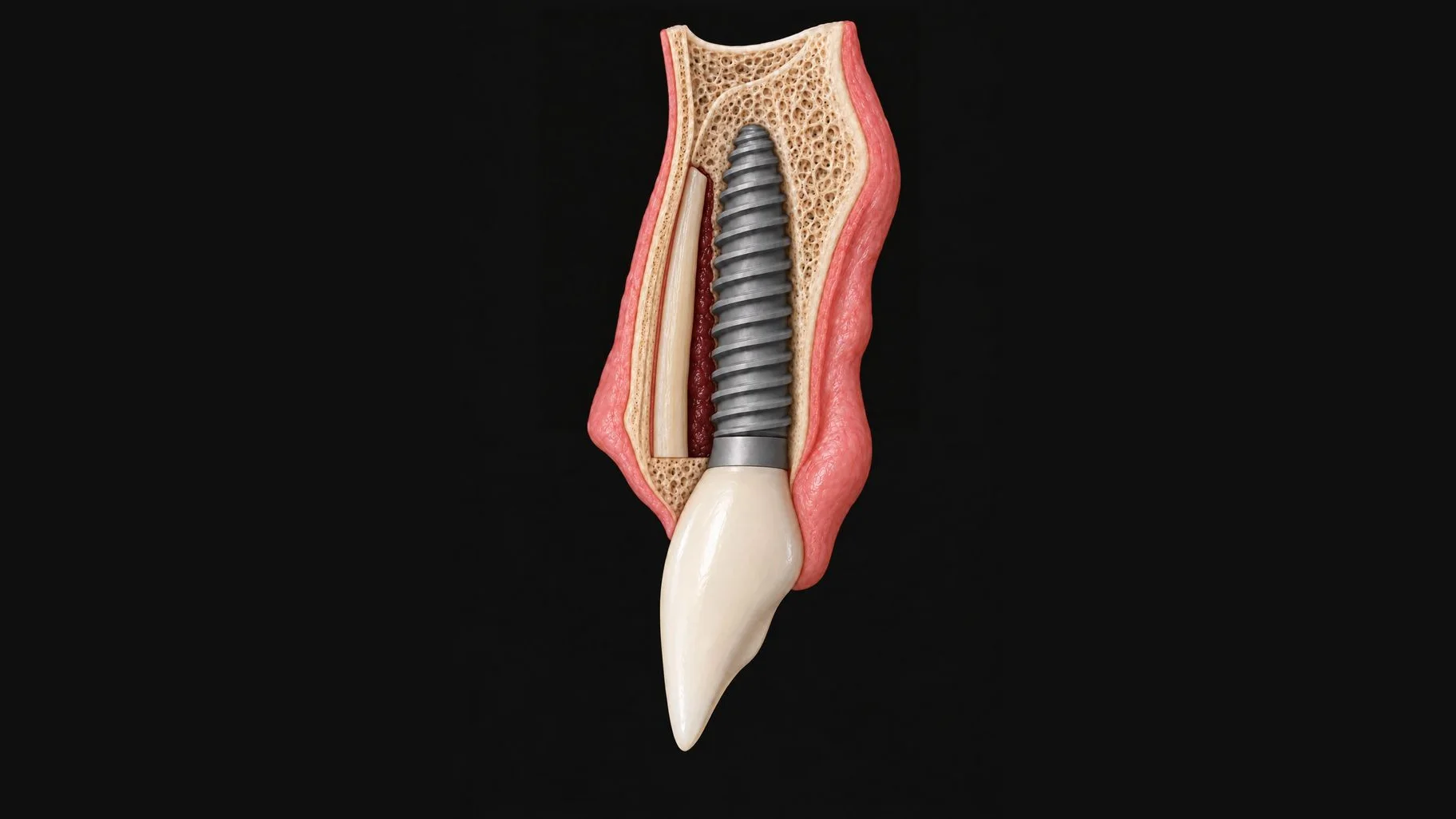 Side view of an upper central incisor site on the day of placement: a thin buccal root shield against the facial bone plate, blood clot between shield and implant, the implant toward the palate, and a provisional crown emerging from the gingiva.