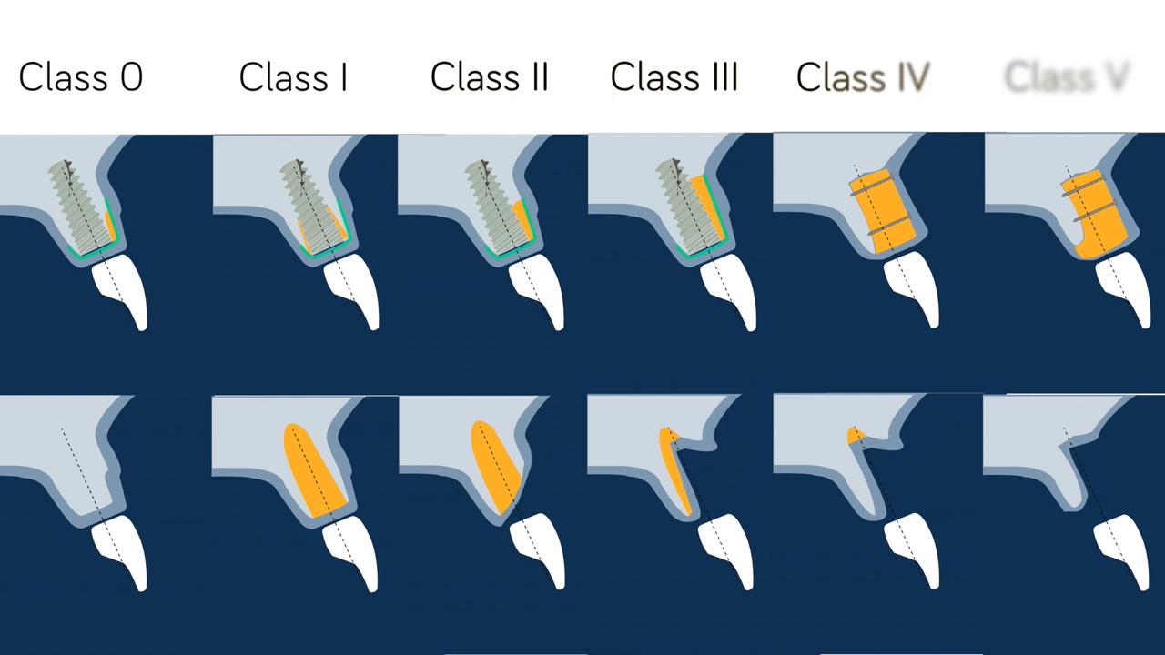 Implant bone defect classification used for GBR planning