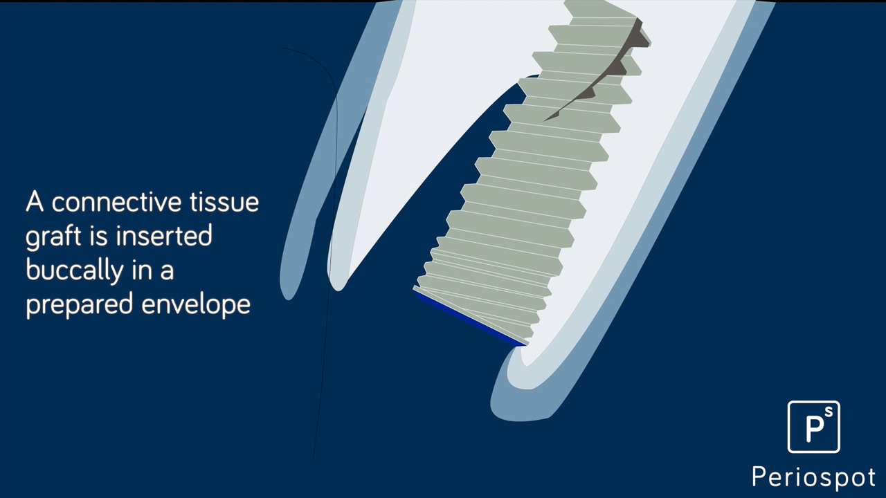 Connective tissue graft inserted buccally in a prepared envelope around an implant