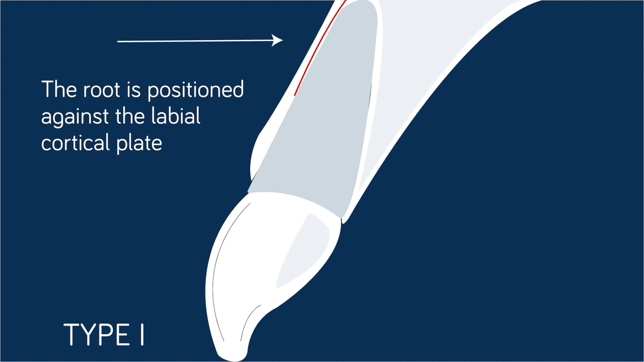 Sagittal socket classification for immediate implant placement