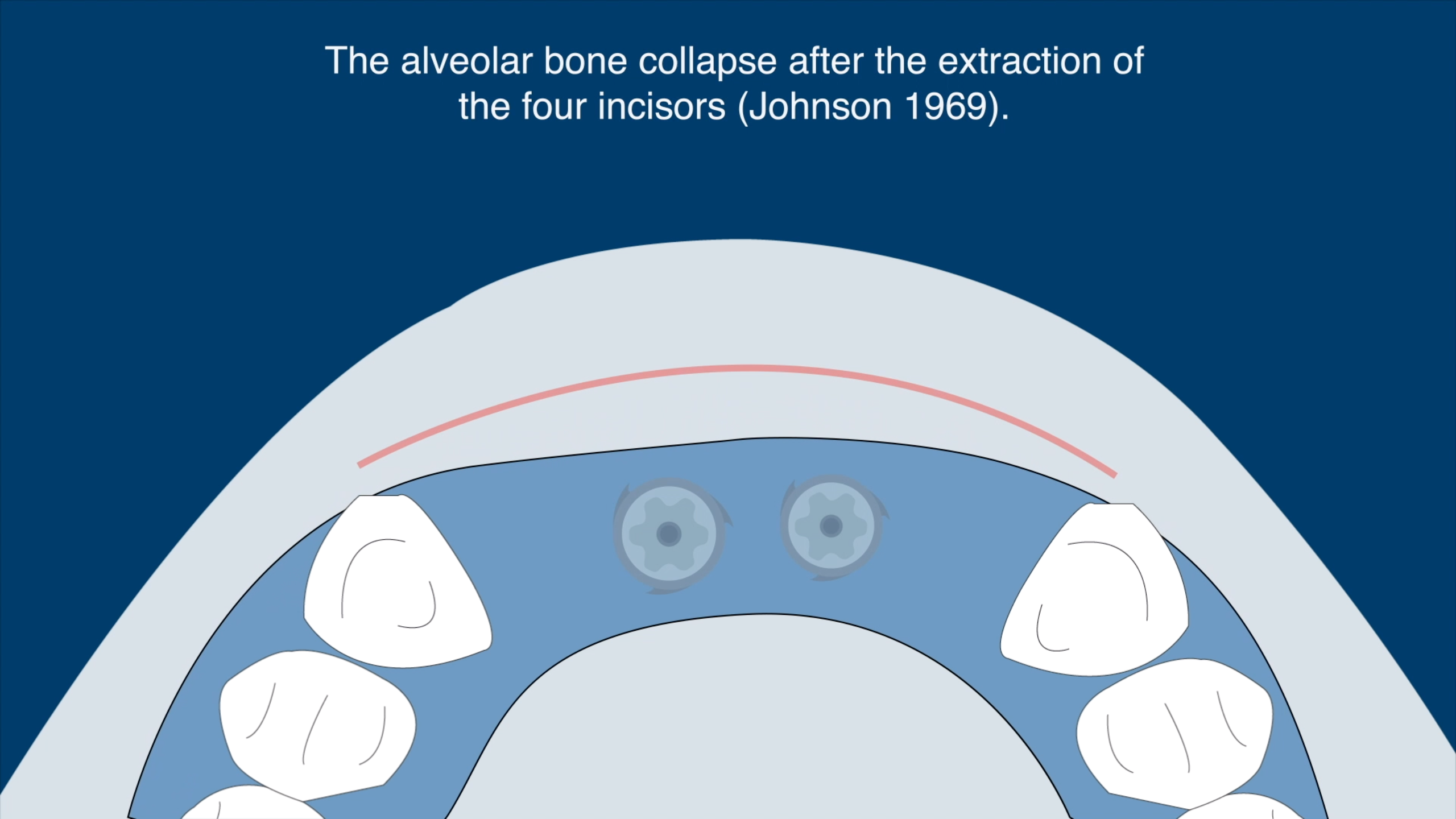 Collagen membrane used for guided bone regeneration