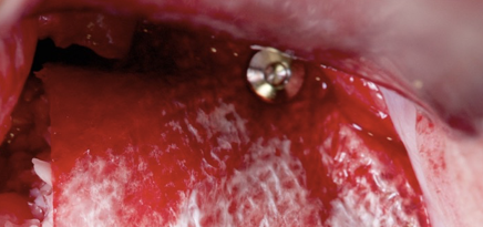 Membrane fixation during guided bone regeneration