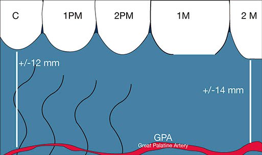 Palatal anatomy and greater palatine artery landmarks for connective tissue graft harvesting