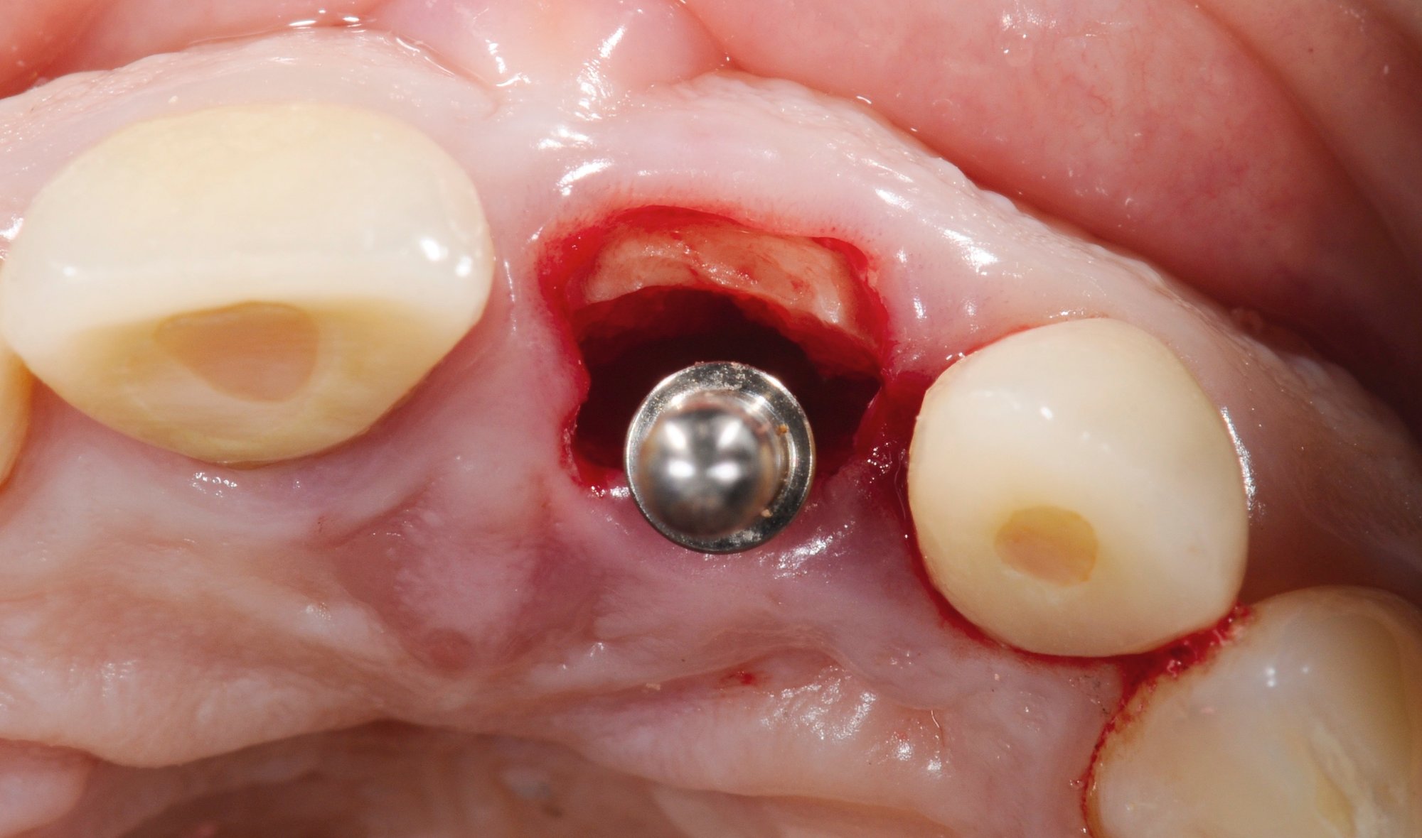 Immediate implant surgical site with implant placed in a fresh extraction socket